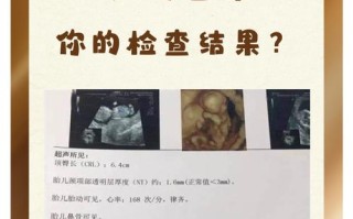 孕期检查NT到底是什么？它对胎儿健康有何重要意义？