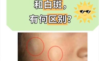 儿童白癜风诱因有哪些？