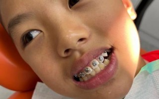 儿童地包天矫正，几岁开始最合适？