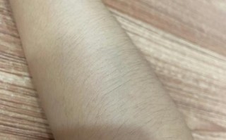 怀孕期间汗毛变密是激素变化导致的正常现象吗？