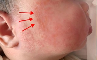 新生儿脸上红血丝会自行消退吗？