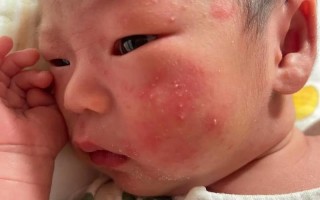 新生儿肚子长红色点点是正常现象还是疾病信号？需警惕哪些潜在风险？