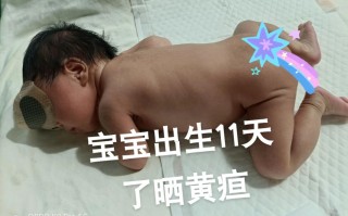 新生儿黄疸身上会发黄吗？黄疸程度与肤色变化有何关联？