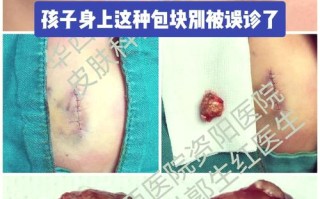 儿童钙化上皮瘤的发病原因是什么？与遗传、外伤或胚胎发育异常有关吗？