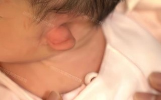 新生儿两耳大小不一怎么办？