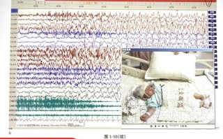 新生儿振幅整合脑电图如何精准评估脑功能发育异常？