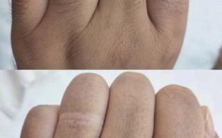 5岁儿童脱发怎么办？安全有效的脱毛方法有哪些？