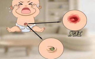 新生儿肚脐分泌物照片正常吗？颜色、性状异常需警惕哪些问题？