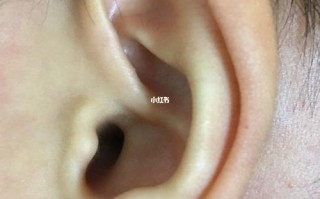 新生儿耳朵上的小点点是什么？需要担心吗？会对听力有影响吗？