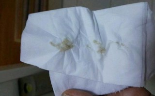 孕期分泌物发黄是正常现象吗？会对胎儿有影响吗？需要怎么处理？