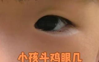 新生儿突然斗鸡眼僵直