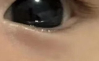 新生儿眼睛进毛纤维了怎么办？家长该如何正确处理和护理？