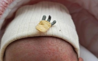 新生儿为何也会长痤疮？是激素影响还是护理不当？