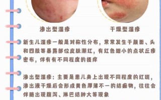 新生儿湿疹该挂皮肤科还是儿科？