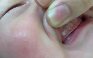新生儿下牙龈出现小白点是什么原因？需要担心吗？