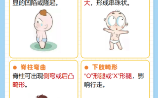 儿童佝偻病是缺啥造成的？