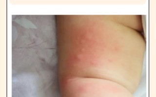 儿童全身瘙痒警惕哪些疾病？