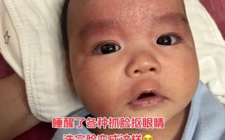新生儿湿疹多久能自行消失？