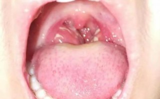 儿童扁桃体肥大，中医能治吗？