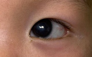 新生儿一个月眼白发黄是正常现象还是黄疸信号？需如何处理？