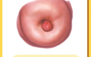 孕期宫颈息肉能手术吗