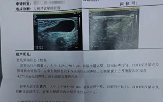 新生儿两侧睾丸大小不一，是正常发育差异还是需要警惕的异常信号？