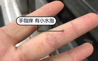 儿童手指缝起小水泡是咋回事？