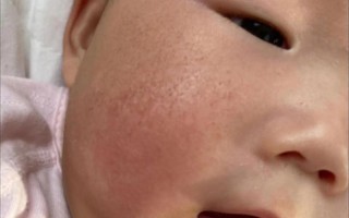 新生儿宝宝脸颊有点黄是正常现象还是健康预警？