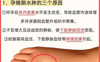 孕期浮肿通常从孕中期开始，但具体因人而异，如何判断是否异常？