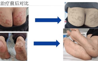 儿童风湿免疫病的症状有哪些容易被家长忽视？如何早期识别与干预？