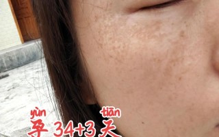 孕期脸斑多怎么办？