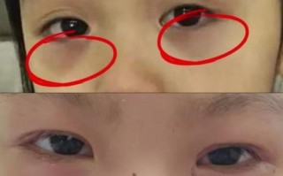 新生儿眼周发青图片是正常现象还是疾病信号？