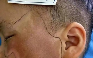 新生儿身上的咖啡斑会随着年龄增长自行消失吗？需要干预吗？