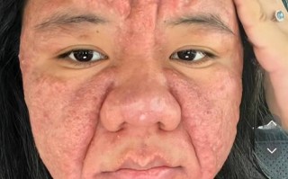 孕期脸上长痘痘真的能预示怀的是男孩吗？这种说法有科学依据吗？