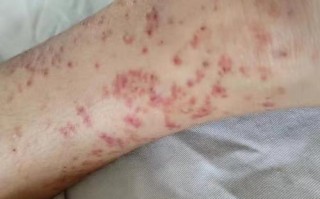 儿童特发性血小板减少性紫癜为何高发？