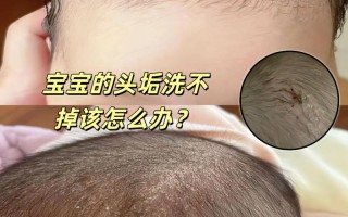 新生儿头发里湿疹反反复复，到底该怎么护理才能好得快？