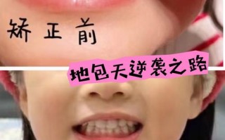 儿童隐形矫正牙齿到底好不好？