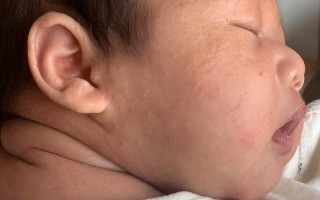 新生儿脸上起小疙瘩怎么回事