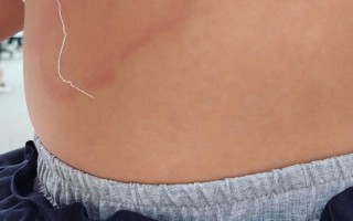 儿童荨麻疹是什么症状