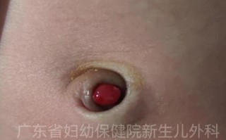 新生儿CH异常严重吗？早发现早干预对宝宝影响有多大？