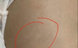 儿童白癜风的初期症状