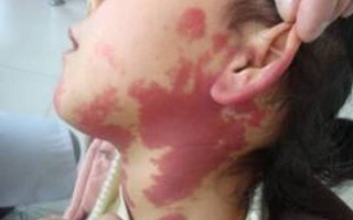 新生儿斑痣和鲜红斑痣有何区别？需要治疗吗？