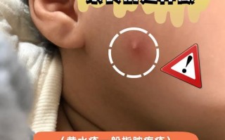 儿童脓毒血症能彻底根治吗？