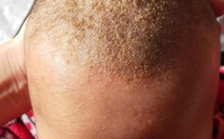 新生儿头上溢脂性皮炎怎么护理？会影响发育吗？反复发作怎么办？