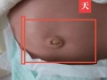 新生儿肚脐脱落后还需消毒吗？
