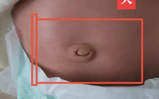 新生儿肚脐脱落后还需消毒吗？