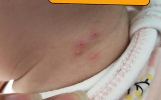 儿童热毒脓疮反复发作怎么办？如何安全有效治疗？