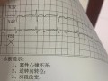 孕期心电图检查具体是查什么的？对胎儿有影响吗？