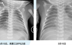 新生儿RDS是什么病？严重吗？能治好吗？家长该怎么办？