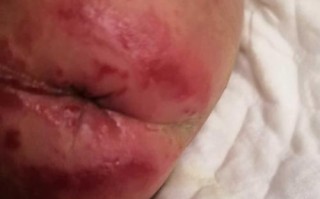 新生儿拉肚子屁股溃烂，该如何护理才能避免加重？